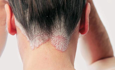 Nấm da đầu rất dễ bị lây lan và bệnh nhân phát hiện cũng rất chậm 