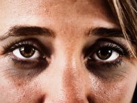 Tìm hiểu về nguyên nhân gây thâm quầng mắt