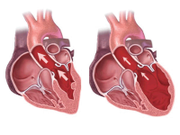 Bệnh thấp tim là gì? Nguyên nhân và dấu hiệu nhận biết thấp tim