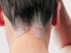 Mắc bệnh nấm da đầu có nên nhuộm tóc không?